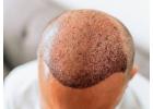 hair transplantation clinic