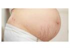 pregnancy stretch marks