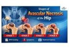 Stages of Avascular Necrosis Hip – Symptoms & Treatment