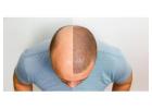 Hair transplant Treatment