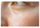 Open Pores Treatment in Delhi – Advanced Skin Refinement Solutions