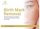 Birthmark Removal Treatment in Indore by Specialists