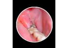 How Wisdom Teeth Infection Removal Helps Pain Fast