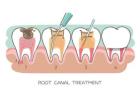 Best Root Canal Treatment in India
