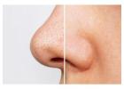 Blackheads Treatment in Delhi for Clear & Healthy Skin