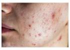 Active Acne Treatment in Delhi for Clear & Healthy Skin