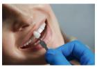 Dental Implants in Mesa, AZ for a Confident Smile