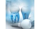 High Quality Dental Implant Manufacturers in Venezuela