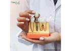 Siiodent Implants: Dental Implant Suppliers For Mexico