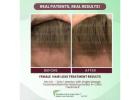 Reclaim Confidence with Natural Solutions for Thinning Hair