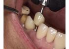 Revive your natural and flawless smiles with holistic Dental care in Tijuana
