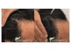 Unlock the Power of Science-Backed Hair Loss Treatment