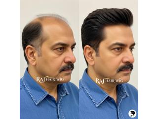Hair Patch in Delhi – Non-Surgical Hair Solutions Hair Patch in Delhi – Non-Surgical Hair Solutions