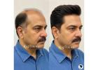 Hair Patch in Delhi – Non-Surgical Hair Solutions