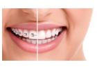 Best Braces Treatment In Gurgaon