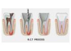 Save Your Tooth – Advanced Root Canal Treatment in Noida