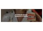 Full Mouth Dental Implants in Mexico with Teeth Savers
