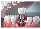 Get Permanent Dental Implants in Mumbai Today