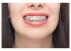 Best Clinic for Braces & Teeth Alignment in Ahmedabad