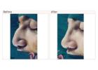 Rhinoplasty Surgery in Delhi - Dr Rajat Gupta