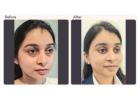 Getting Double Eyelids: Is Surgery Safe and Necessary?