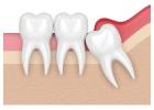 Wisdom Tooth Removal in