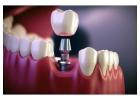 Restore Your Smile with Best Dental Implants in Mumbai