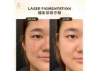 Erase Dark Spots Safely with Advanced Laser Treatment