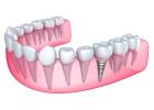 Dental Implants in Islamabad – What Makes Them Different from Dentures