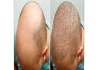 Hair Transplant Surgery In Florida