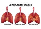 Lung Cancer Singapore: Symptoms, Diagnosis and Early Detection