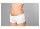 How Much is Liposuction Surgery? A Clear Cost Breakdown