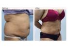 Latest Liposuction Technologies Used by Leading Surgeons