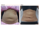 Liposuction Surgery Cost in Delhi - Dr Rajat Gupta