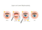 Eyelid surgery cost in Delhi - Dr Rajat Gupta