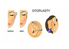 Ear Reshaping Surgery in Delhi - Dr Rajat Gupta