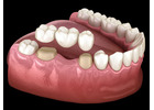 Dental Crown & Bridges in Noida for Smile Restoration