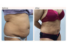 Liposuction Surgery in Delhi - Dr Rajat Gupta 