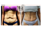Tummy Tuck Surgery in Delhi - Dr Rajat Gupta