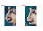 Nose surgery cost in Delhi - Dr Rajat Gupta