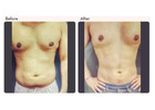 Liposuction Surgeon in Delhi - Dr Rajat Gupta