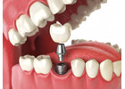 Dental Implants in Abbotsford, BC | Complete Patient Guide