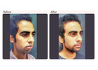 Chin Augmentation in Delhi - Dr Rajat Gupta