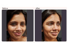 Dimple Creation Surgery in Delhi - Dr Rajat Gupta