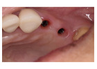 Full Mouth Dental Implants in Mexico with Teeth Savers