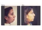 Chin Augmentation in Delhi - Dr Rajat Gupta