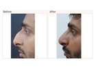 Rhinoplasty Surgery in Delhi - Dr Rajat Gupta