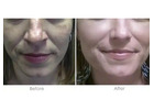 Real Microneedling Before and After 3 Treatments