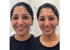 Ross Bridge Medical Center: Laser Hair Reduction in Hoover