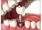 Dental Fillings in Abbotsford | Restore Your Smile